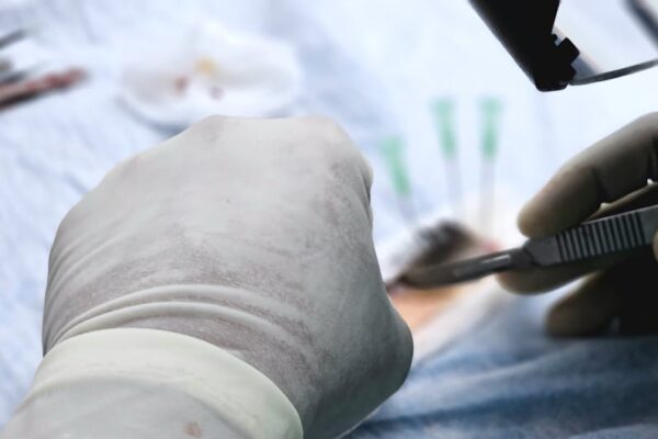 Hair Transplant